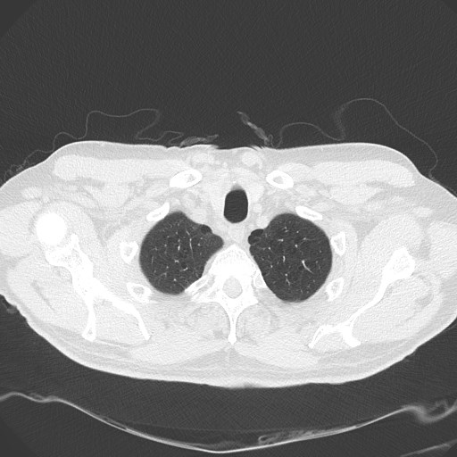 Caplan syndrome (Radiopaedia 56667-63530 Axial lung window 28).jpg