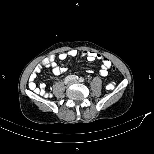 Caput medusae sign - portal hypertension (Radiopaedia 64007-72759 A 63).jpg