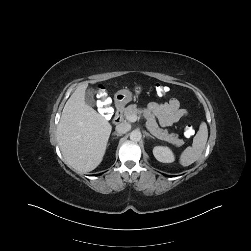 Carcinoid tumor - terminal ileum (Radiopaedia 60931-68739 A 41).jpg