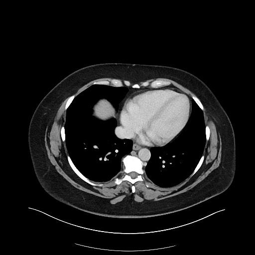 File:Carcinoid tumor - terminal ileum (Radiopaedia 60931-68739 Axial 127).jpg