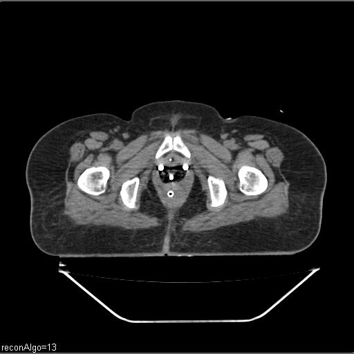 Carcinoma cervix- brachytherapy applicator (Radiopaedia 33135-34173 Axial non-contrast 44).jpg