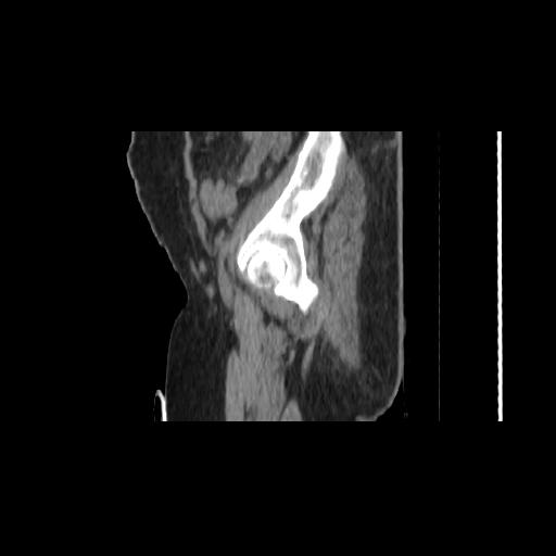 File:Carcinoma cervix- brachytherapy applicator (Radiopaedia 33135-34173 D 17).jpg