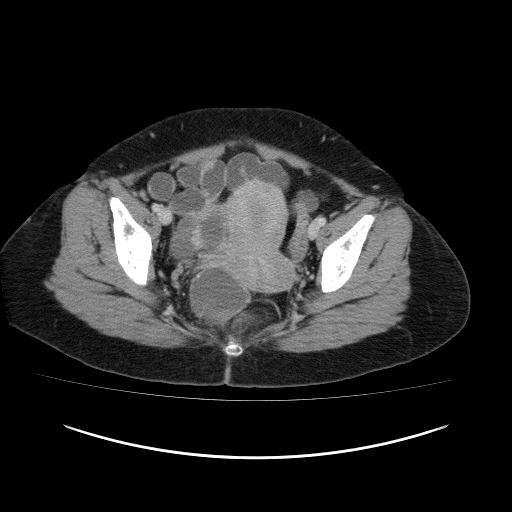File:Carcinoma colon - hepatic flexure (Radiopaedia 19461-19493 A 114).jpg