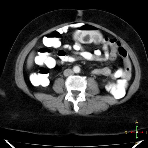 File:Carcinoma of sigmoid colon (Radiopaedia 23071-23100 C+ arterial phase 14).jpg