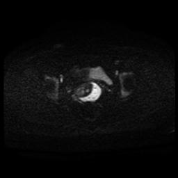 Carcinoma of the cervix (Radiopaedia 89018-105858 Axial DWI 53).jpg