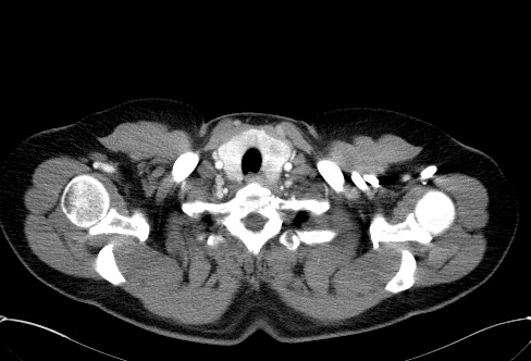 Cardiac sarcoidosis (Radiopaedia 74548-85534 A 3).jpg