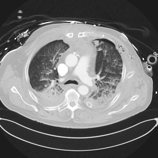 Cardiac trauma (Radiopaedia 32874-33858 Axial lung window 21).jpg