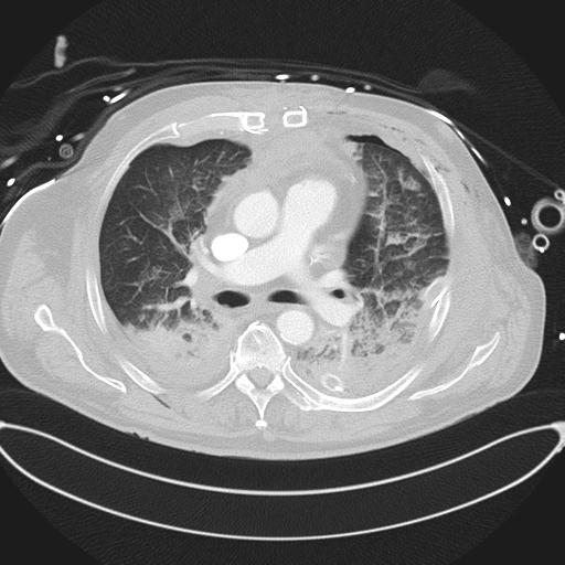 Cardiac trauma (Radiopaedia 32874-33858 Axial lung window 24).jpg
