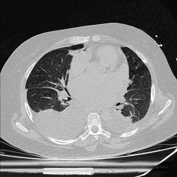Cardiogenic pulmonary edema (Radiopaedia 29213-29609 Axial lung window 52).jpg