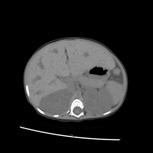 File:Caroli disease with autosomal recessive polycystic kidney disease (ARPKD) (Radiopaedia 89651-106703 Axial non-contrast 19).jpg