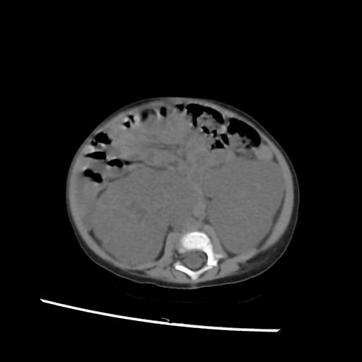 File:Caroli disease with autosomal recessive polycystic kidney disease (ARPKD) (Radiopaedia 89651-106703 Axial non-contrast 35).jpg