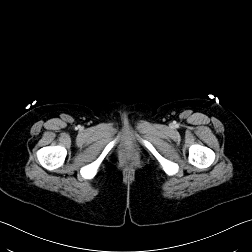Caroli disease with medullary sponge kidney (Radiopaedia 82622-96804 C 82).jpg