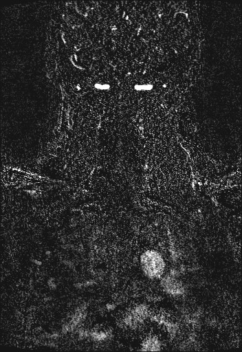 Carotid artery dissection (Radiopaedia 28441-28689 Coronal MRA 84).jpg