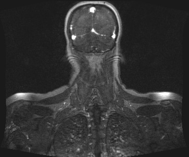 Carotid body tumor (Radiopaedia 12777-12912 MRA 68).jpg
