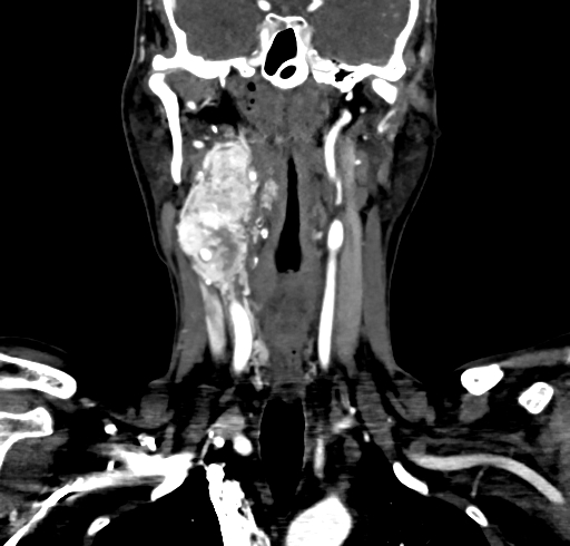 File:Carotid body tumor (Radiopaedia 83615-98727 B 66).jpg