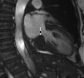 File:Caseous calcification of the mitral valve annulus (Radiopaedia 47717-52411 B 1).jpg