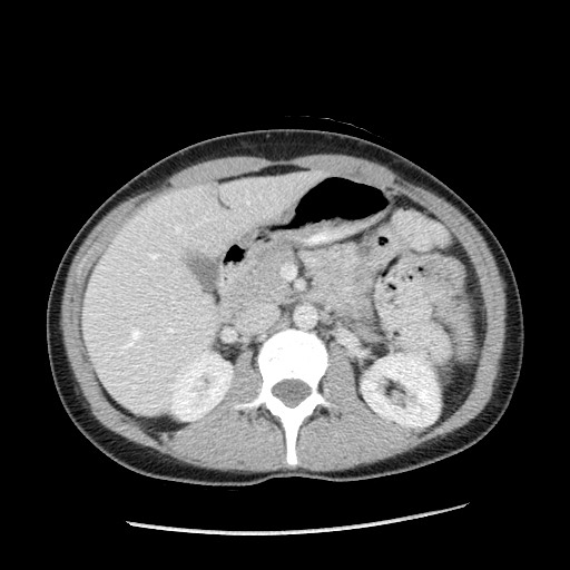 Castleman disease with fibrous pseudotumor in the abdomen (Radiopaedia 77296-89373 A 44).jpg