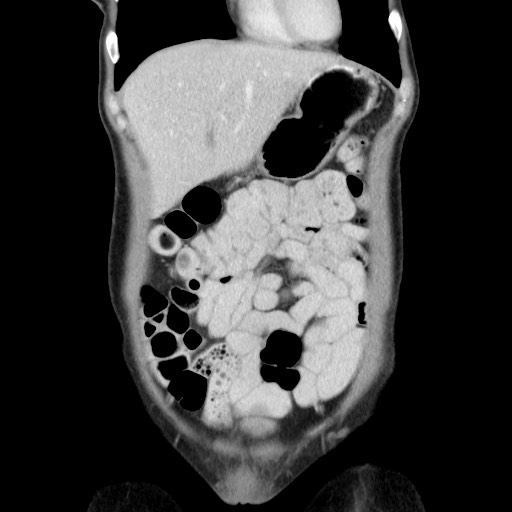 Castleman disease with fibrous pseudotumor in the abdomen (Radiopaedia 77296-89373 B 23).jpg