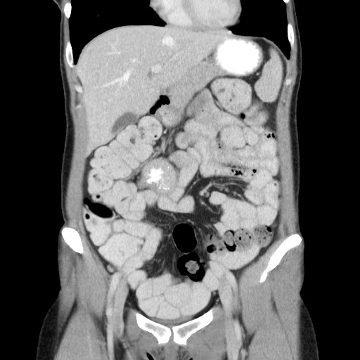 Castleman disease with fibrous pseudotumor in the abdomen (Radiopaedia 77296-89373 B 32).jpg