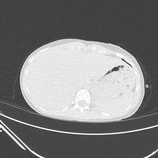 Catamenial pneumothorax (Radiopaedia 27946-28197 lung window 151).jpg