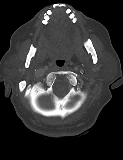 Causes of dysphagia (Radiopaedia 40149-42657 Axial bone window 15).png