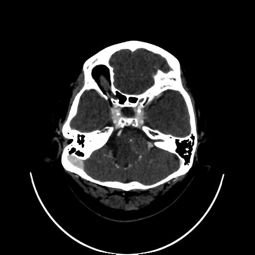 Cavernoma with developmental venous anomaly (Radiopaedia 22470-22506 C 27).jpg