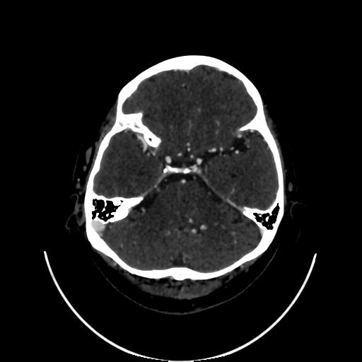 Cavernoma with developmental venous anomaly (Radiopaedia 22470-22506 C 39).jpg