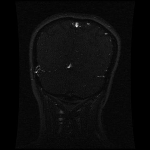 Cavernoma with developmental venous anomaly (Radiopaedia 22470-22507 MRV 41).jpg