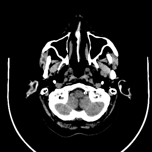 Cavernous hemangioma of the cerebellar falx (Radiopaedia 73025-83723 Axial non-contrast 11).jpg