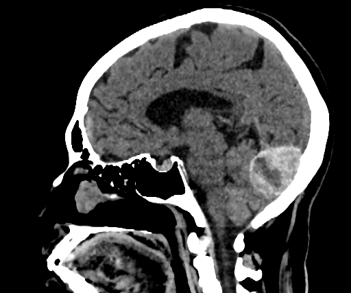 Cavernous hemangioma of the cerebellar falx (Radiopaedia 73025-83723 B 175).jpg