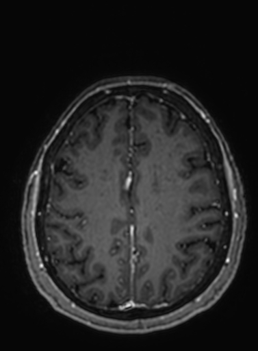 File:Cavernous hemangioma of the cerebellar falx (Radiopaedia 73025-83724 Axial T1 C+ 101).jpg