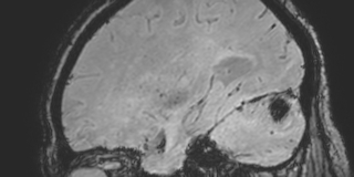 Cavernous hemangioma of the cerebellar falx (Radiopaedia 73025-83724 Sagittal BOLD 60).jpg