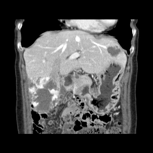 Cavernous hepatic hemangioma (Radiopaedia 75441-86667 C 45).jpg