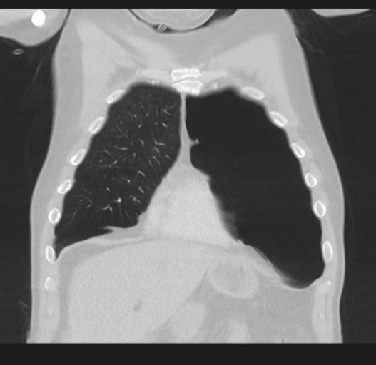 Cavitating pneumonia complicated by pneumothorax (Radiopaedia 48149-52994 Coronal lung window 15).png