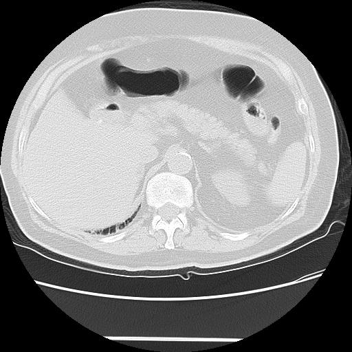 Cavitating pulmonary metastases (Radiopaedia 89545-106544 Axial lung window 57).jpg