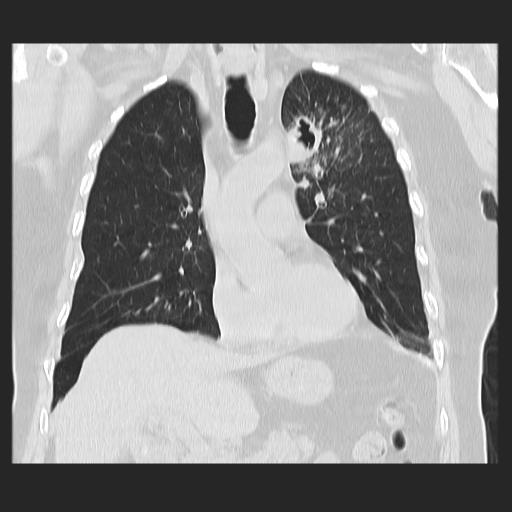 File:Cavitating pulmonary metastases (Radiopaedia 89545-106544 Coronal lung window 17).jpg