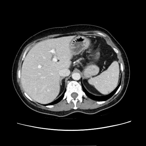 Cecal adenocarcinoma (Radiopaedia 75909-87331 A 25).jpg