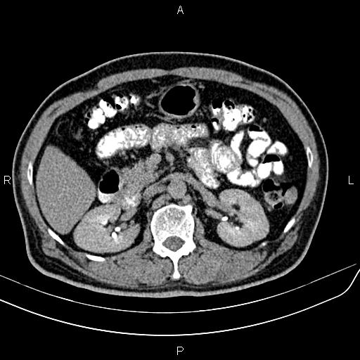 File:Cecal cancer with appendiceal mucocele (Radiopaedia 91080-108651 Axial C+ delayed 19).jpg