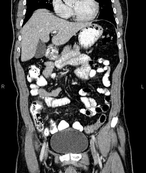File:Cecal cancer with appendiceal mucocele (Radiopaedia 91080-108651 D 25).jpg