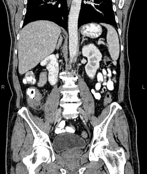 Cecal cancer with appendiceal mucocele (Radiopaedia 91080-108651 D 44).jpg
