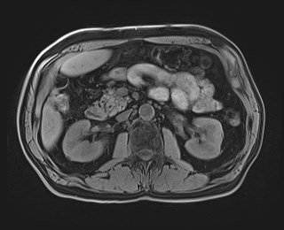 Cecal mass causing appendicitis (Radiopaedia 59207-66532 Axial T1 58).jpg