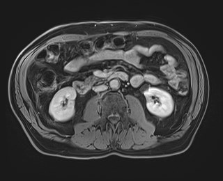 Cecal mass causing appendicitis (Radiopaedia 59207-66532 J 68).jpg