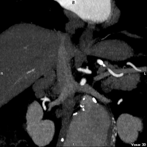 File:Celiac artery anatomy (Radiopaedia 16763-16476 A 11).jpg