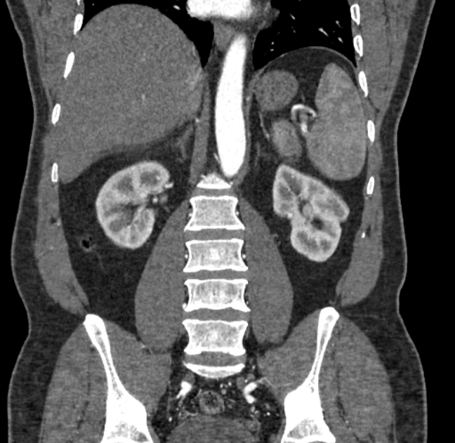Celiac artery dissection (Radiopaedia 52194-58080 C 94).jpg