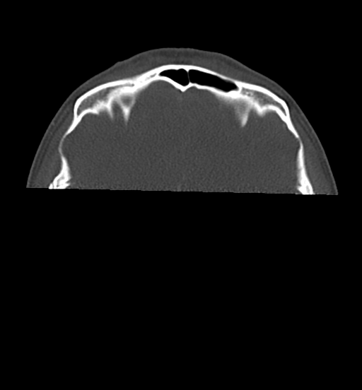 File:Cemento-ossifying fibroma (Radiopaedia 46243-50643 Axial bone window 11).png