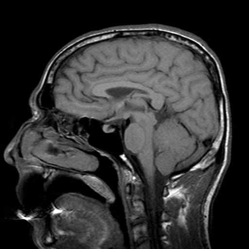 File:Central-variant posterior reversible encephalopathy syndrome (PRES) (Radiopaedia 43880-47358 Sagittal T1 11).jpg