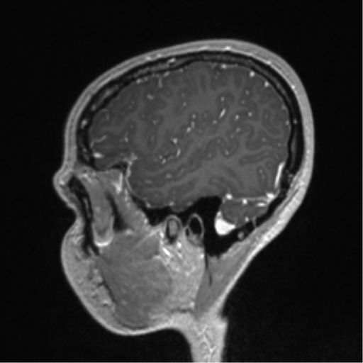 Central neurocytoma (Radiopaedia 37664-39557 Sagittal T1 C+ 78).png