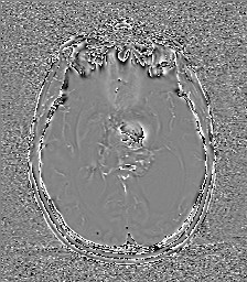 Central neurocytoma (Radiopaedia 84497-99872 Axial 35).jpg