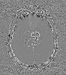 File:Central neurocytoma (Radiopaedia 84497-99872 Axial 37).jpg