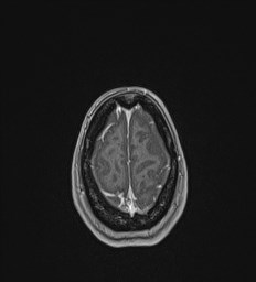 Central neurocytoma (Radiopaedia 84497-99872 Axial T1 C+ 137).jpg
